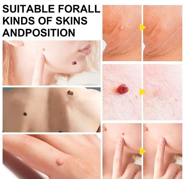 Skin Tag Removal Tool Kit