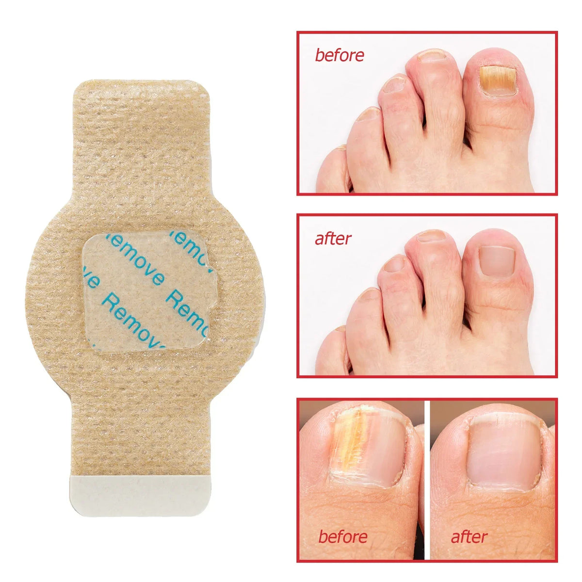 Fungal Nail Patches